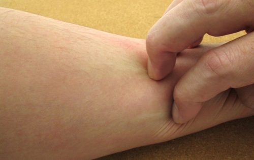 蜂に刺された「カユミ痛み症状を長引かせないため」の処置法
